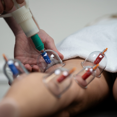 cupping-1-therapy-Movement Specialists-physical-therapy-metairie-Mandeville-LA